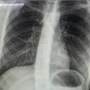 A chest x-ray I recently had (for dif reasons) You can see the curviness!